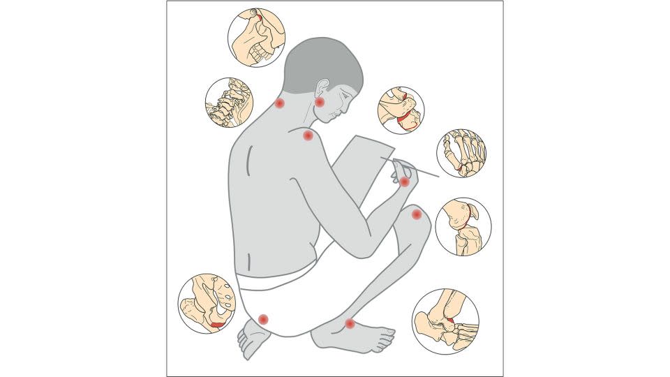 A drawing shows the parts of the skeleton most affected by the sitting positions and work carried out by scribes. - Jolana Malátková/Archive of Czech Institute of Egyptology, Faculty of Arts, Charles University