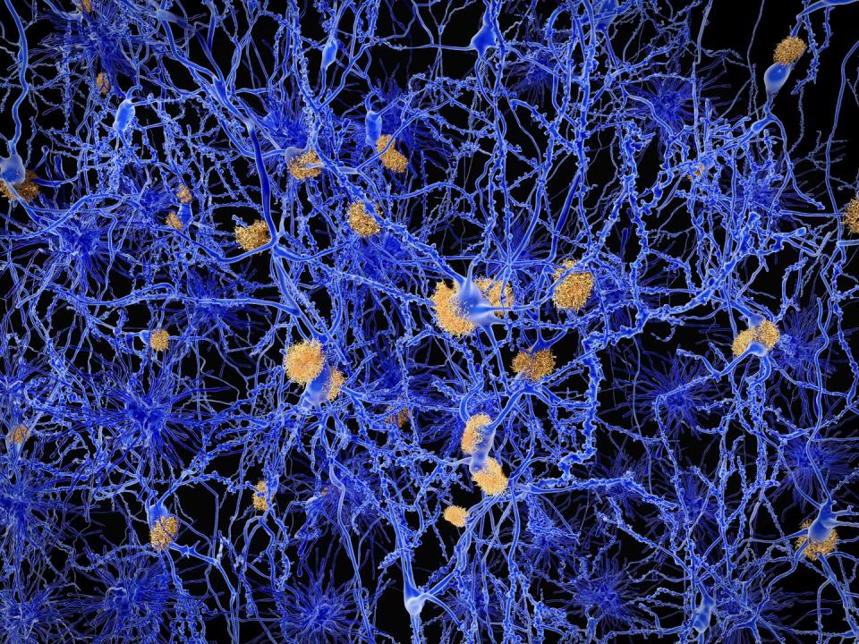 A computer illustration of amyloid plaques, characteristic features of Alzheimers disease.