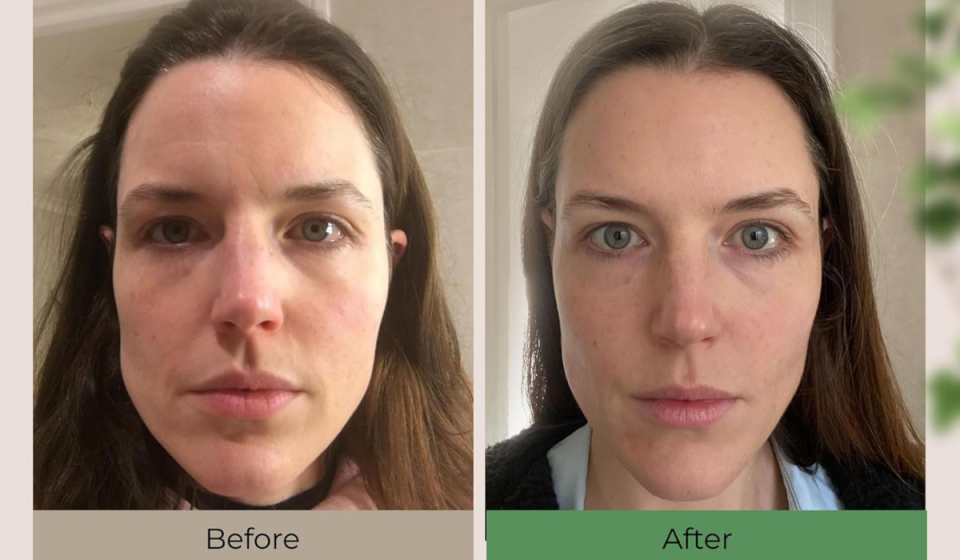 woman's face before and after using moisturizer, with the after showing smoother, more even-toned skin