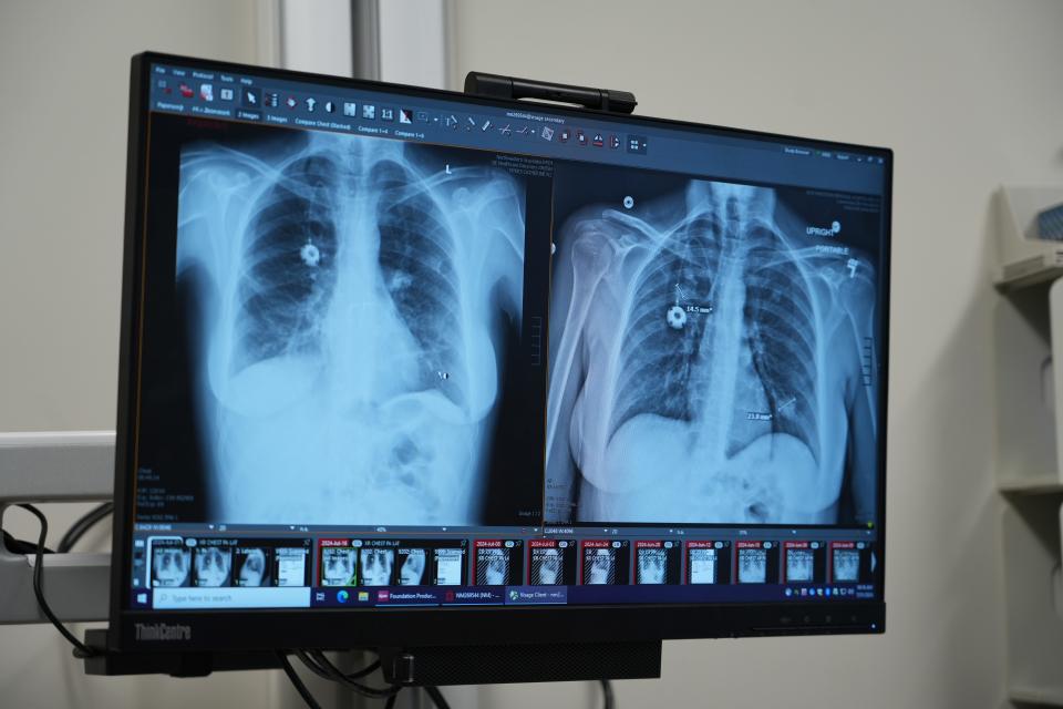 Mandy Wilk's lungs before (right) and after (left) her double lung transplant on June 3, 2024.