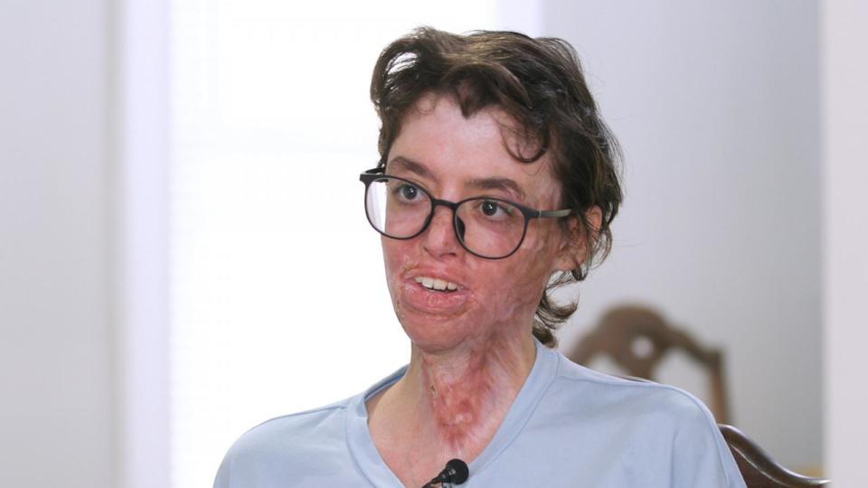 PHOTO: Sara Bsaiso, now 18, has undergone several surgeries since she was injured in December 2023. She said she is getting better every day but her only dream right now is “stability,' Aug. 2024. (ABC News)